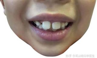 腺样体面容初期图片 腺样体面容初期图片